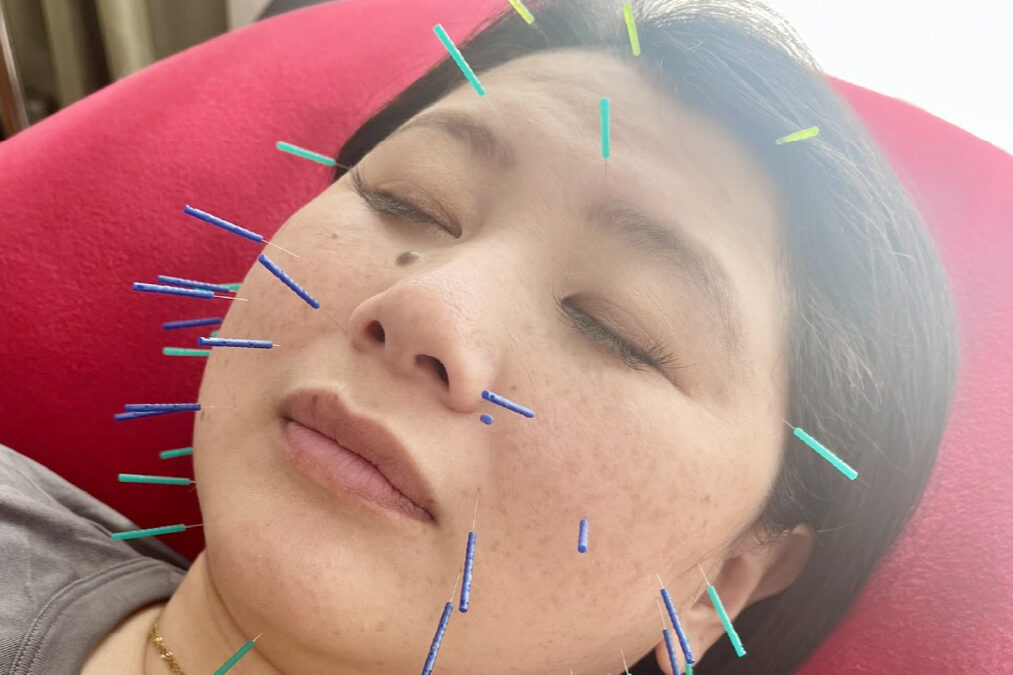 鍼治療をしている画像