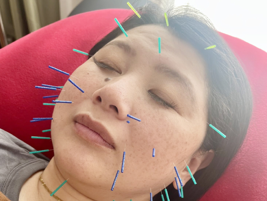 鍼治療をしている画像