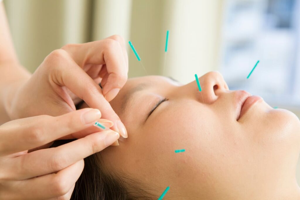 女性の顔に鍼治療をしている画像